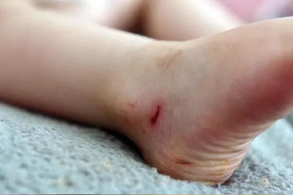 Không sử dụng mặt nạ khi chân bị vết thương hở