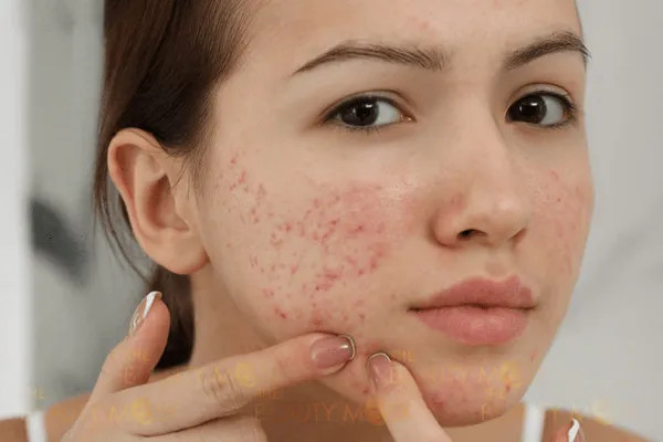 Các Mặt Nạ Trị Mụn Từ Thiên Nhiên Cực Hiệu Quả Tại Nhà