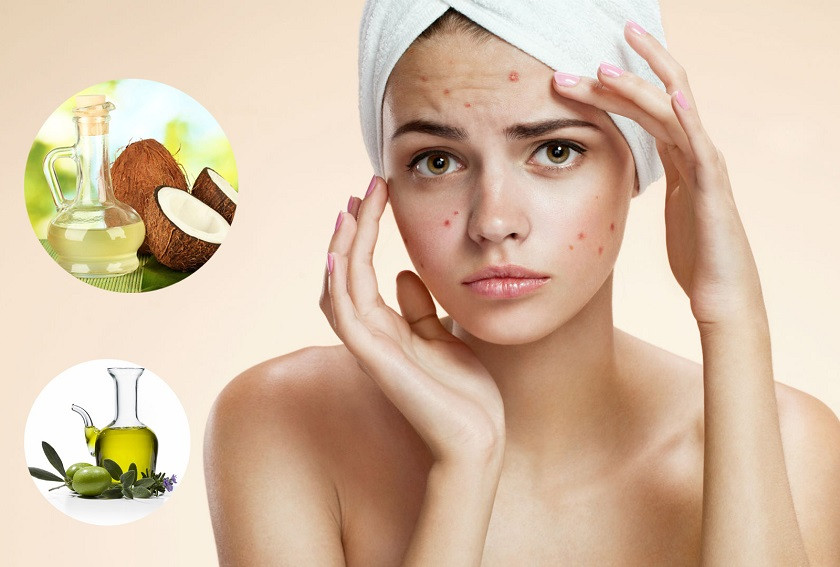Trị mụn bằng dầu dừa